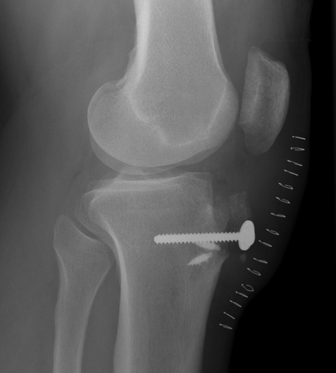 Patella Tendon ORIF